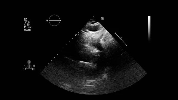 Image Heart Gray Scale Mode Transesophageal Ultrasound — Stock Photo, Image