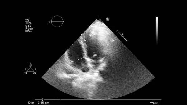 Imagem Coração Escala Cinza Durante Ultrassonografia Transesofágica — Fotografia de Stock
