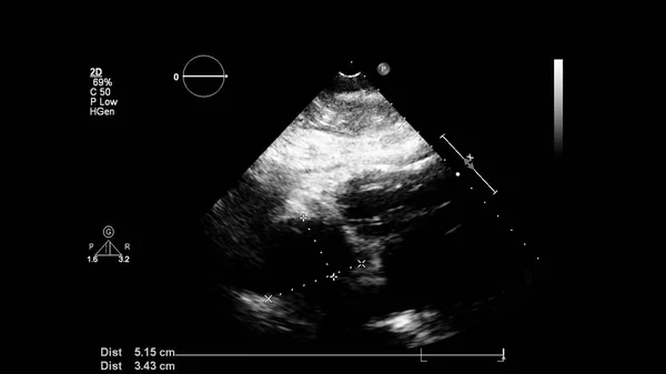 Transesofageal Ultrason Sırasında Kalbin Gri Ölçekli Görüntüsü — Stok fotoğraf