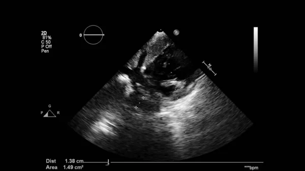 Afbeelding Van Het Hart Grijs Schaal Modus Tijdens Transesofageale Echografie — Stockfoto