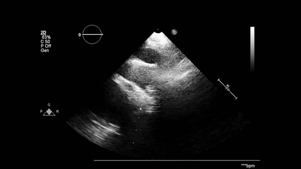 Image Heart Gray Scale Mode Transesophageal Ultrasound — Stock Photo, Image