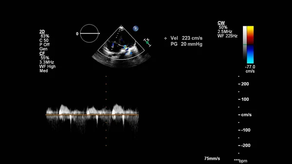 Imagem Coração Durante Ultrassom Transesofágico Com Modo Doppler — Fotografia de Stock