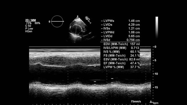 Image of the heart in gray-scale mode during transesophageal ultrasound.
