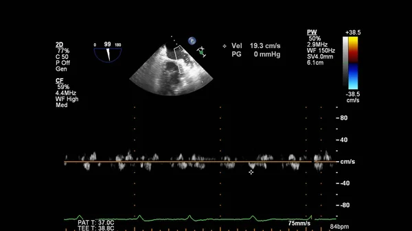 Imagen Del Corazón Durante Ecografía Transesofágica Con Modo Doppler —  Fotos de Stock