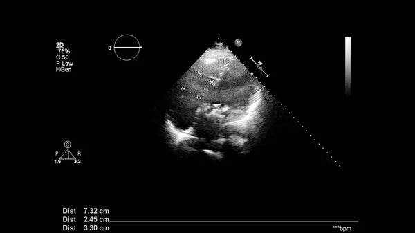 Transesofageal Ultrason Sırasında Kalbin Gri Ölçekli Görüntüsü — Stok fotoğraf