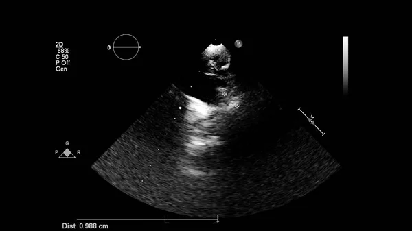 Bild Hjärtat Gråskala Transesofagalt Ultraljud — Stockfoto