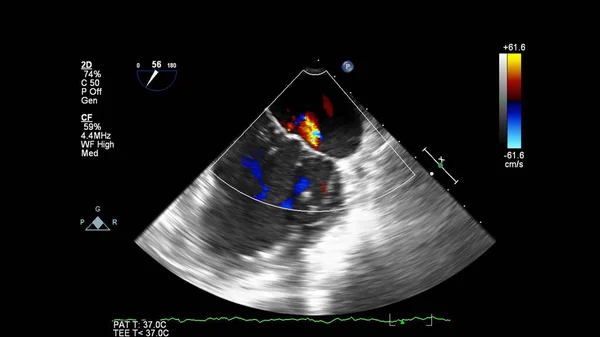 Beeld Van Het Hart Tijdens Transesofageale Echografie Met Doppler Modus — Stockfoto