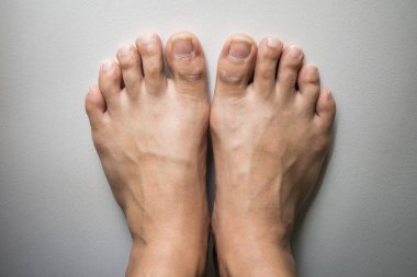 Beyaz beton arka plan üzerinde ayak ve uzun tırnak ayak lar. Uzun tırnaklar ve kirli mantar neden olabilir.