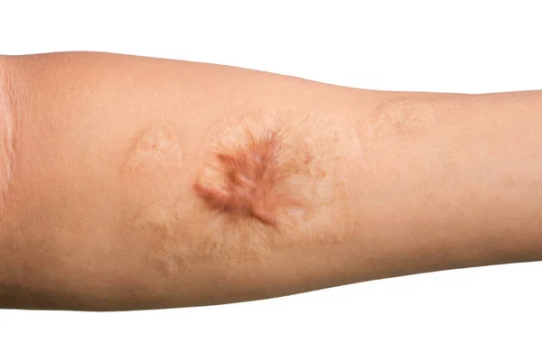 Close Keloid Litteken Hypertrofische Litteken Huid Van Man Arm Ongeval — Stockfoto