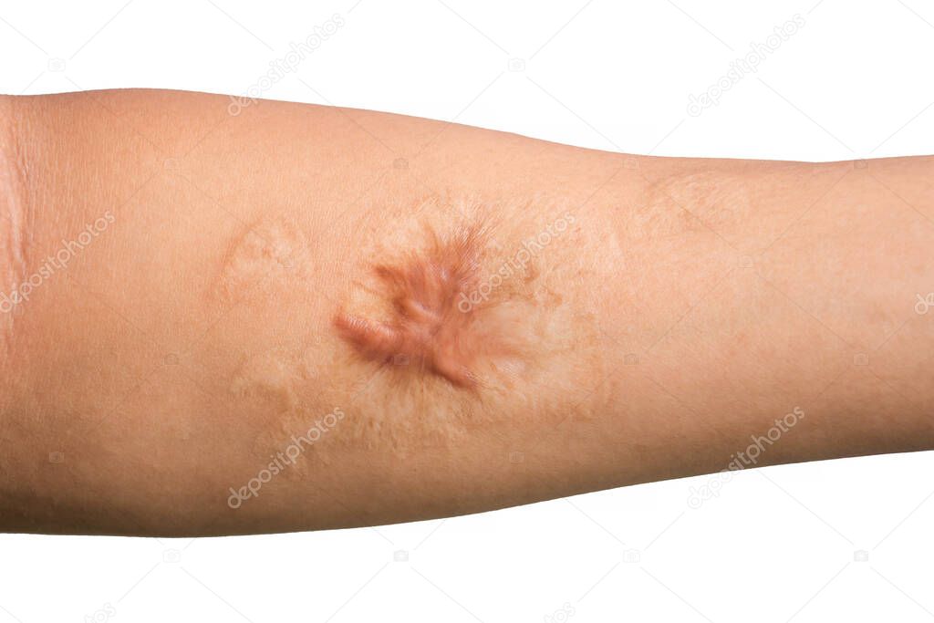 Close up Keloid scar (Hypertrophic Scar) on man arm skin after accident isolated on white background.