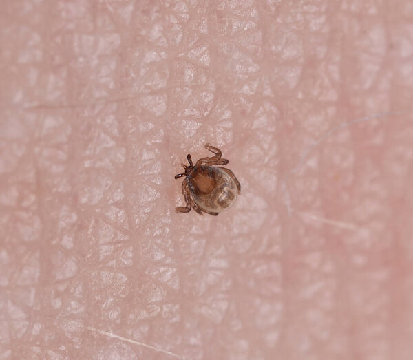 Castor beam tick, Ixodes ricinus nymph feeding on human photographed with high magnification, this animal is a carrier of diseases 