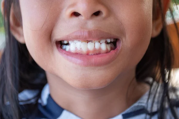 Stacked Front Tooth Problem Children Parents Should Take See Dentist — Stock Photo, Image