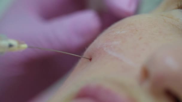 Косметологи сдают розовые перчатки, делая инъекцию наполнителя для лица взрослой женщине со шприцем, с видом на макрос. процедура инъекции красоты . — стоковое видео