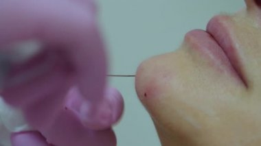 Kozmetologlar, yetişkin kadınlara şırınga ve makro görüş enjekte ederek yaşlanmayı önleyici yüz dolgusu yapan pembe eldivenler veriyorlar. Güzellik enjeksiyon prosedürü.