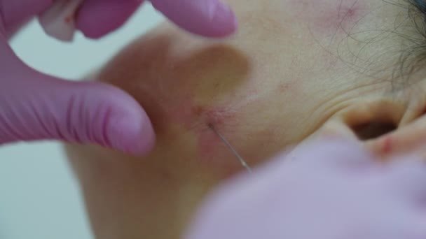 美容师用粉红手套为成年女性注射抗衰老面部充填剂，宏观透视。美容注射程序. — 图库视频影像