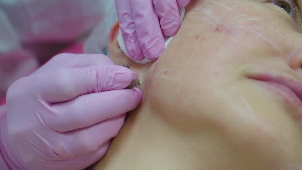 Cosmetologists mão em luvas rosa fazendo injeção de enchimento facial anti-envelhecimento para mulher adulta com seringa, visão macro. Procedimento de injeção de beleza . — Vídeo de Stock
