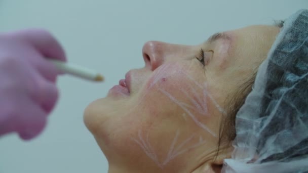 Cosmetólogos mano en guantes de color rosa dibujo en la cara con lápiz que se prepara para la inyección de relleno facial anti-envejecimiento a la mujer adulta, vista macro. Procedimiento de inyección de belleza . — Vídeo de stock