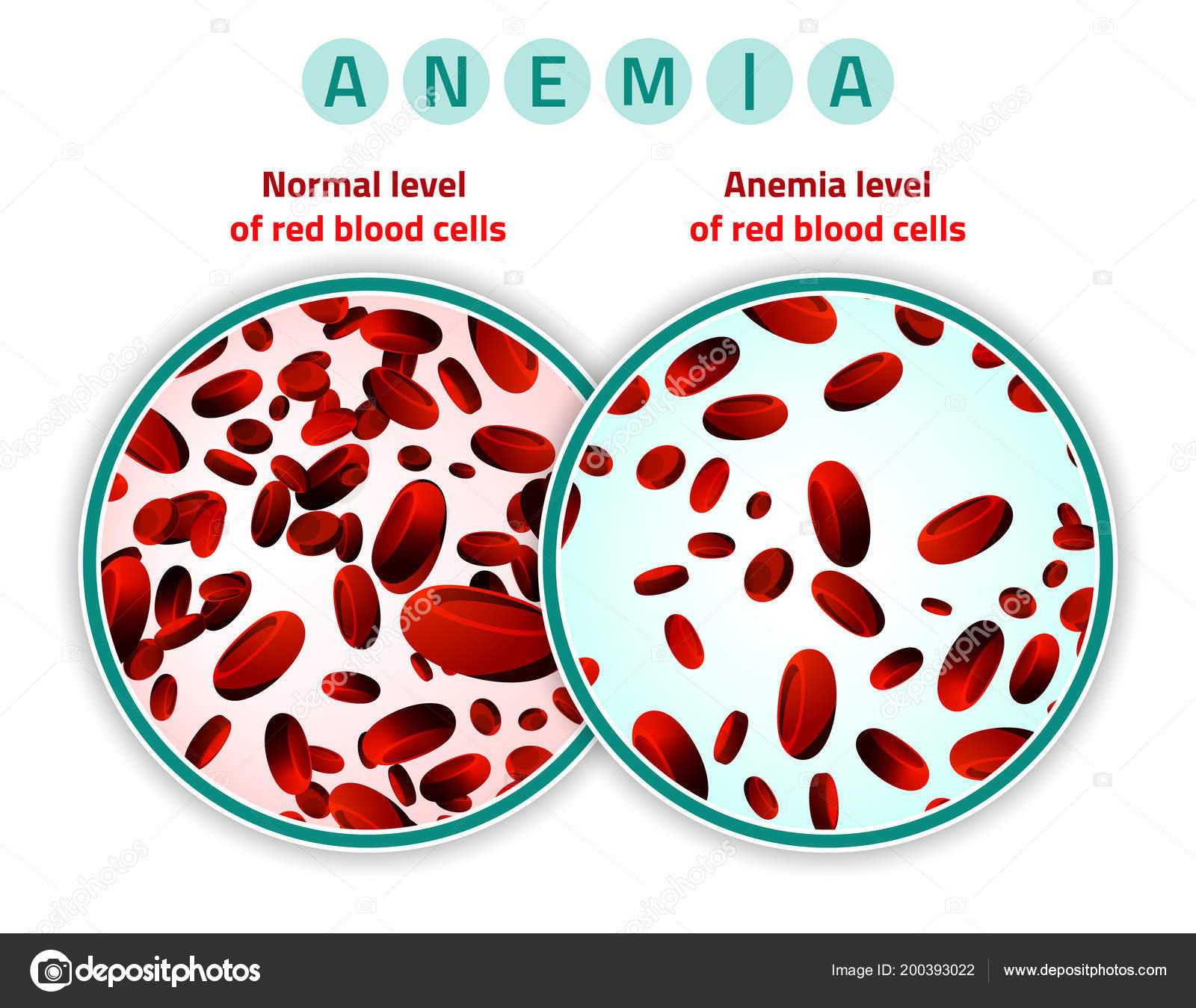Anemia level of blood cells Stock Vector Image by ©annyart #200393022 Anemia level of blood cells Stock Vector Image by ©annyart #200393022