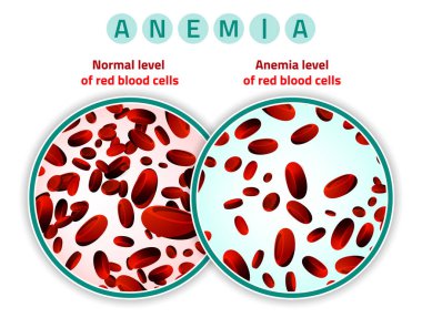 Anemia level of blood cells clipart