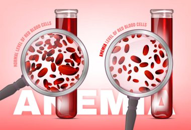 Anemia level of blood cells clipart