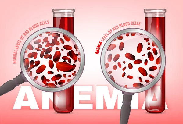 Nivel de anemia de las células sanguíneas — Vector de stock