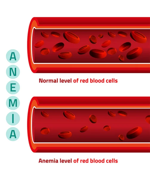 Nivel de anemia de las células sanguíneas — Vector de stock