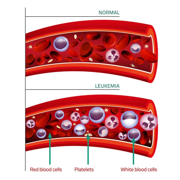 Imagen infográfica de la leucemia — Vector de stock