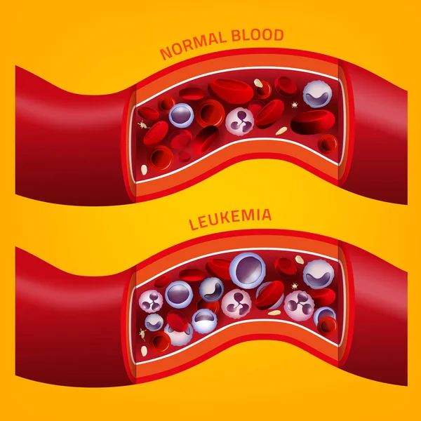 Imagen de conciencia de la leucemia — Vector de stock