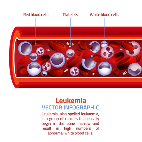 Leukemia blood vessel — Stock Vector