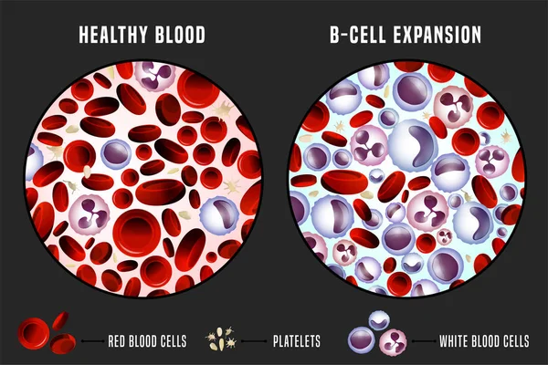 Imagen infográfica de la leucemia — Archivo Imágenes Vectoriales