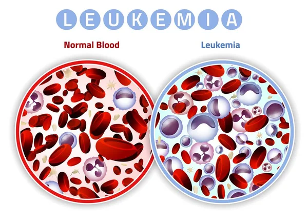 Imagen infográfica de la leucemia — Vector de stock