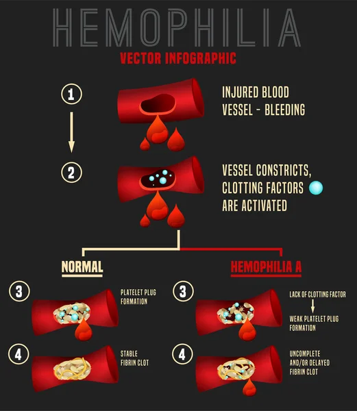 Hemophilia Infographics Image — Stock Vector