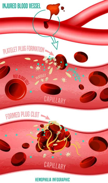 Blood clot formation — Stock Vector