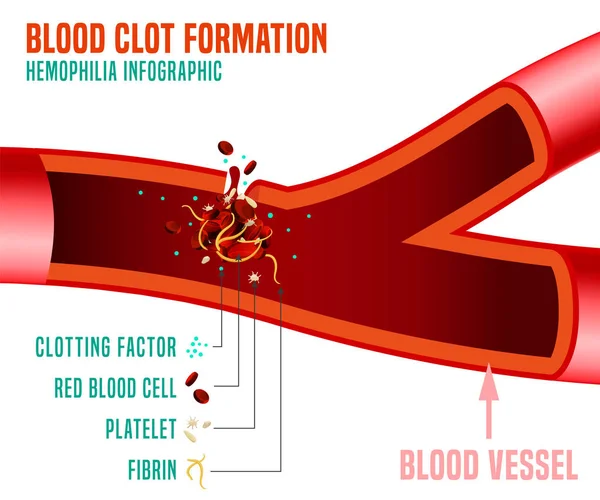 Blood clot formation — Stock Vector