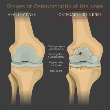 Diz osteoartrit aşamaları