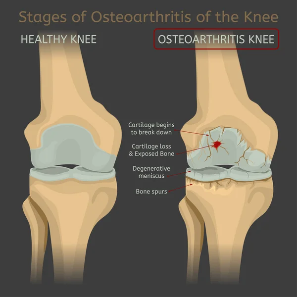 Estágios de osteoartrite do joelho —  Vetores de Stock