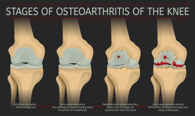 Diz osteoartrit aşamaları