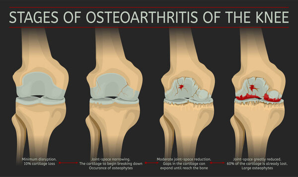 Stages of osteoarthritis of the knee