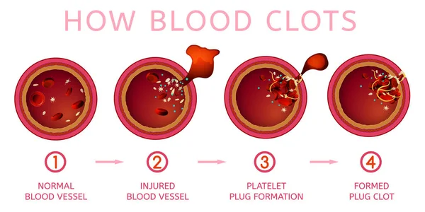 Blood clotting process — Stock Vector