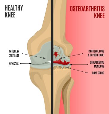 Osteoartrit diz Poster
