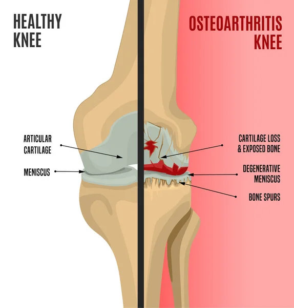 Osteoartritis Rodilla Poster — Vector de stock