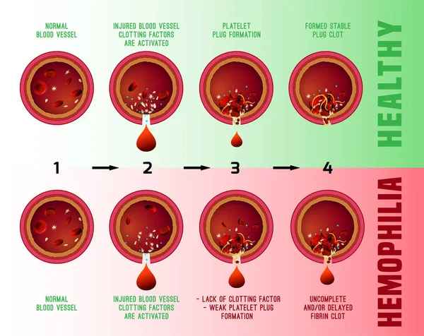 Esquema de coagulação do sangue —  Vetores de Stock