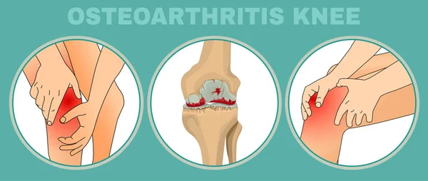 Affiche sur l'arthrose au genou — Image vectorielle