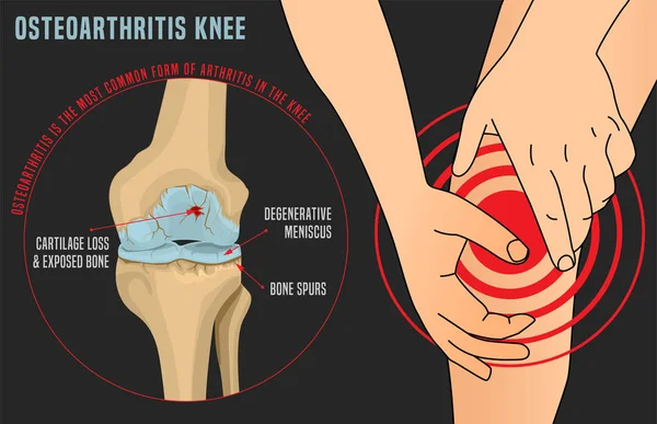 Cartaz de joelho de osteoartrite — Vetor de Stock