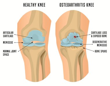Osteoartrit diz Poster