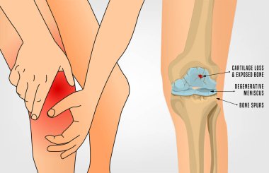 Osteoartrit diz. Hafif bir arka plan üzerinde izole detaylı gerçekçi tarzda düzenlenebilir vektör çizim. Tıp, sağlık ve tıp kavramı. Bilimsel Infographic.