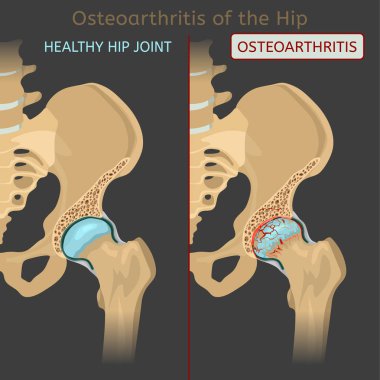 Kalça osteoartriti. Synovial eklemlerin dejeneratif hastalığı. Düzenlenebilir vektör çizim gerçekçi tarzda gri bir arka plan üzerinde izole. Tıp, sağlık, fizyoloji kavramı. Bilimsel Infographic