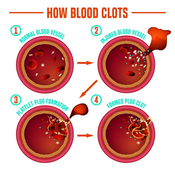 Blood clotting process — Stock Vector