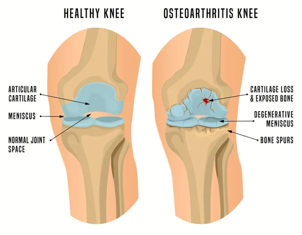 膝の変形性関節症ポスター — ストックベクタ