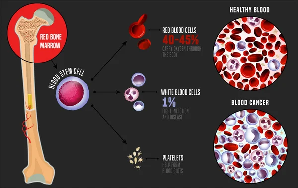 Leucemia infografía médica — Vector de stock